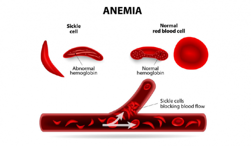鐮狀細胞疾病與臍血